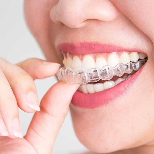 Accessori-per-apparecchi-ortod